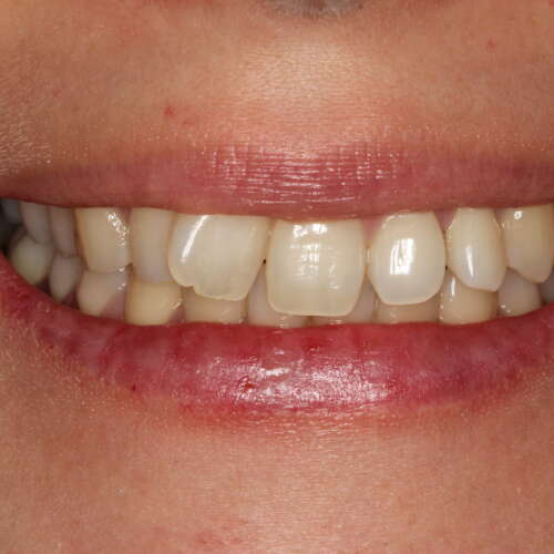 severely rotated front tooth