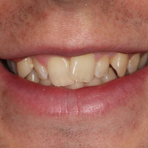 heavily twisted lateral incisors as central teeth overlapping & the canine teeth sticking out