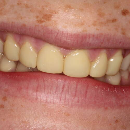 discoloured composite veneers on upper front 6 teeth