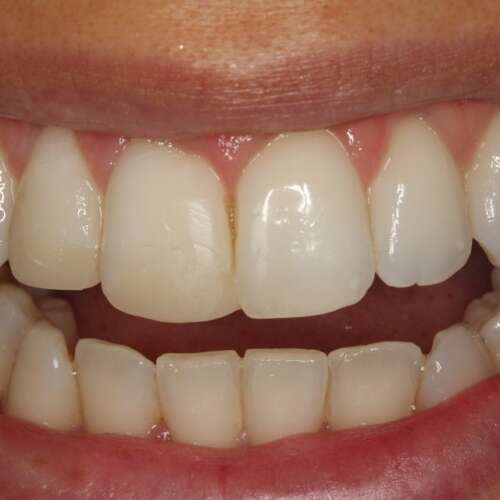 before replacing old composite fillings