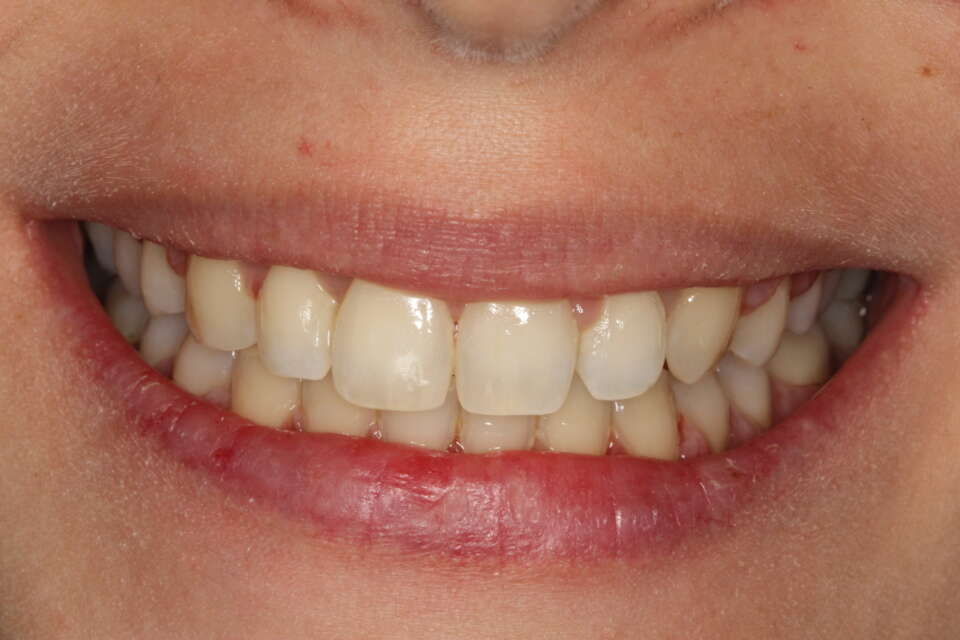 smile transformed with invisalign treatment