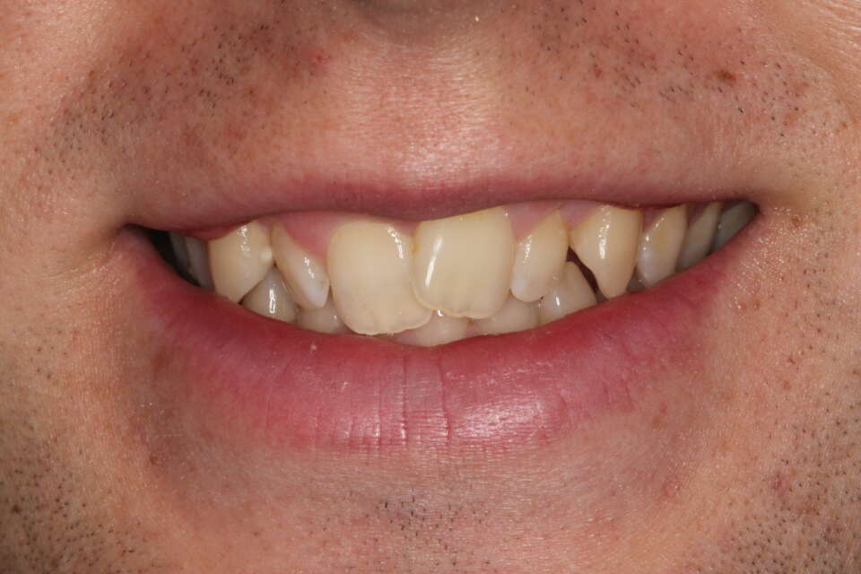 heavily twisted lateral incisors as central teeth overlapping & the canine teeth sticking out