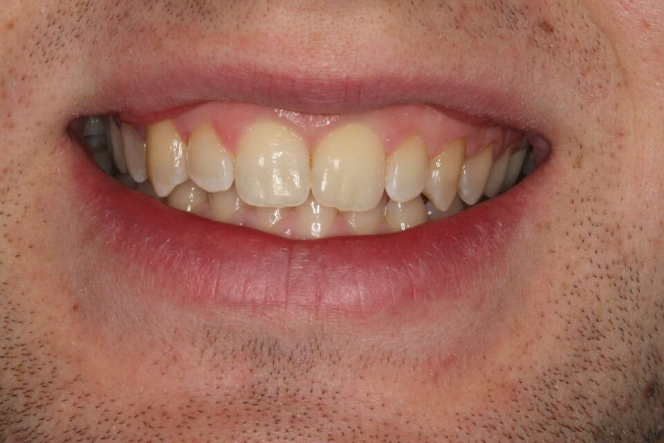teeth after invisalign treatment