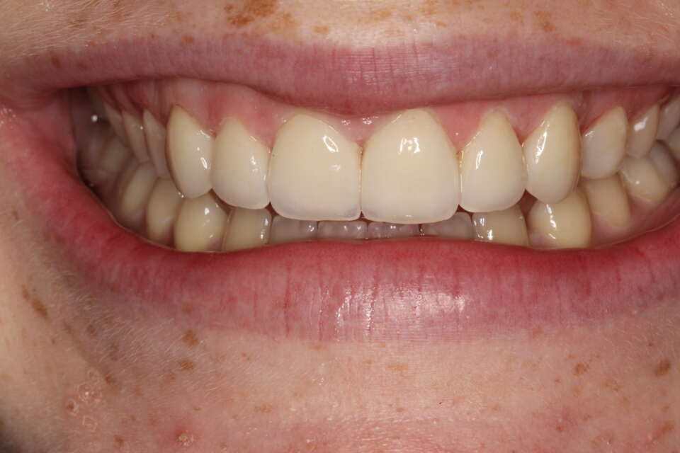 translucency & light reflection on porcelain veneers