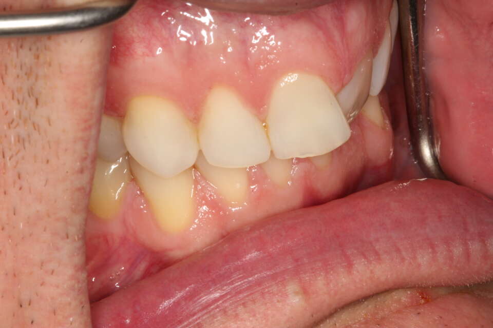 overlapping and twisted front teeth