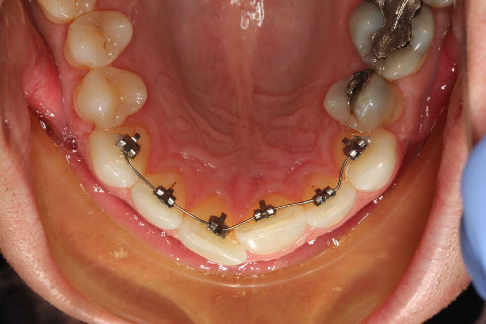 social 6 lingual brace in situ, completely invisible