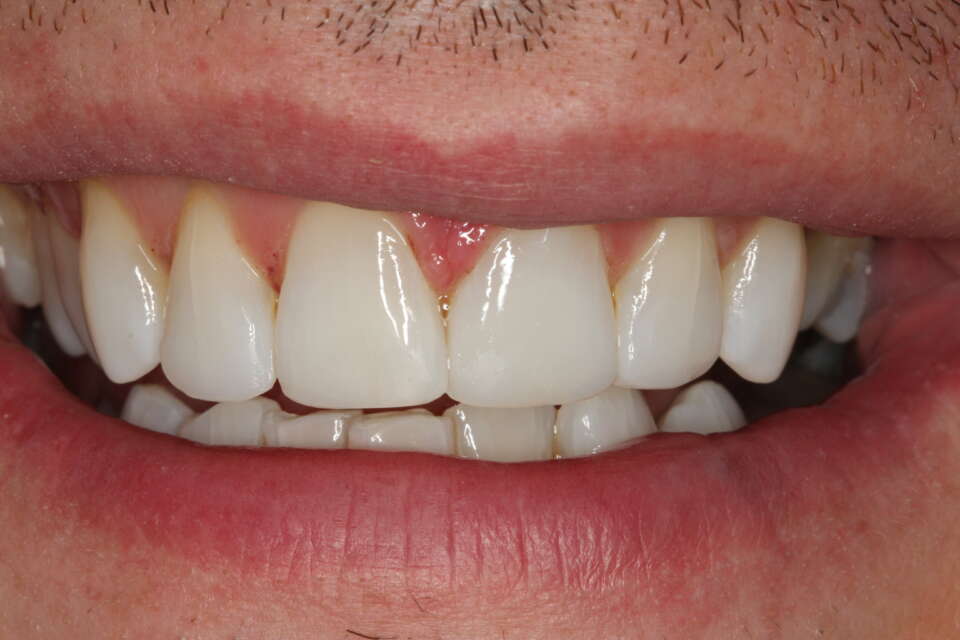 straight teeth! Whitening & composite bonding was carried out for a whiter & more even smile.