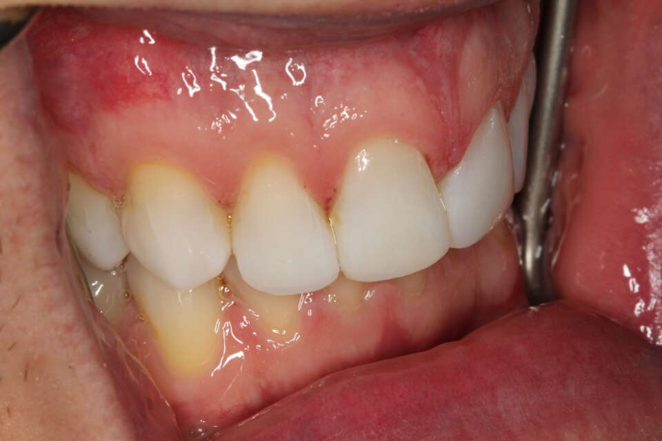 side view of teeth after social 6 lingual brace treatment