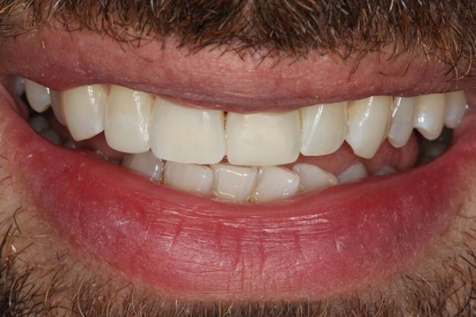 After lingual brace and cosmetic bonding