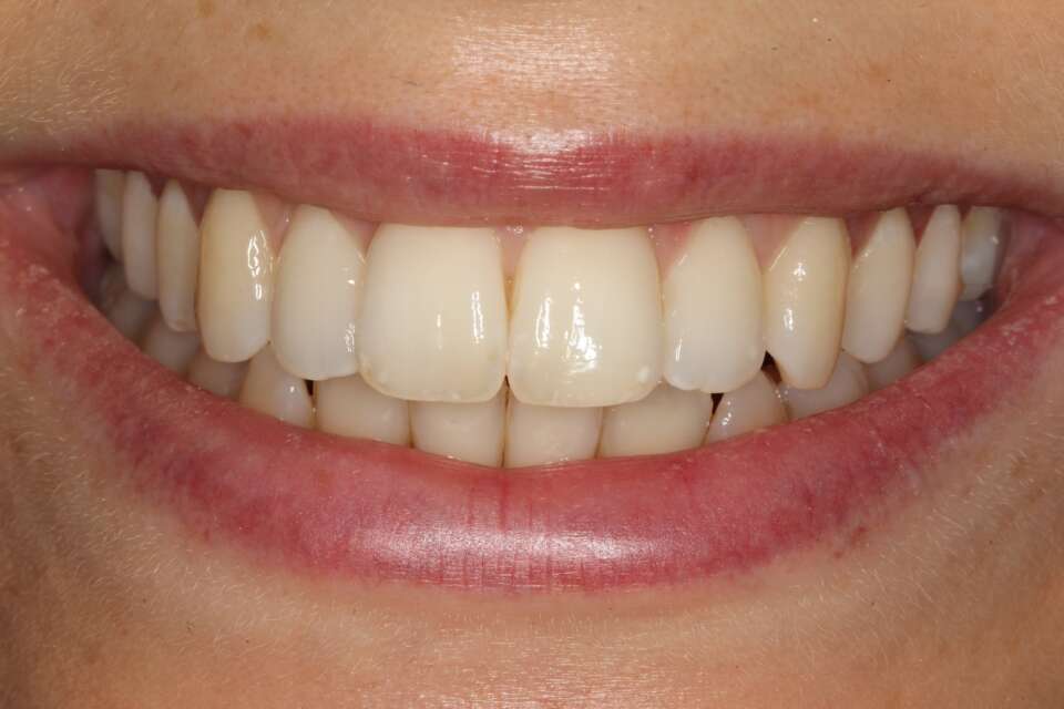 after replacing old composite fillings