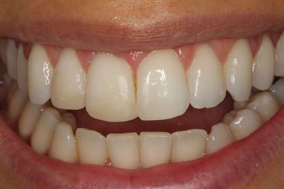 before replacing old composite fillings